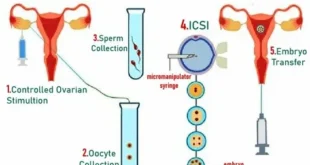 Automated ICSI, Embryo Strategies, and Microfluidics