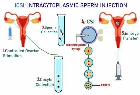Automated ICSI, Embryo Strategies, and Microfluidics