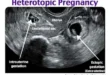 Clinical Outcomes of Heterotopic Pregnancy After IVF