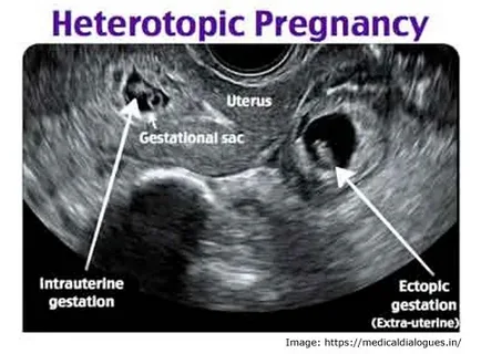Clinical Outcomes of Heterotopic Pregnancy After IVF