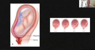rare pregnancy complications after IVF