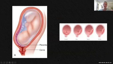 rare pregnancy complications after IVF