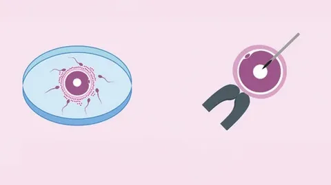 IVF vs IVG: Key Differences